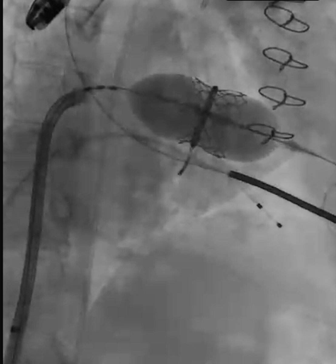 mirvatalasnag's tweet photo. #SundaySamples
#Structural♥️
🪐Oversized valve doesn’t foreshorten as much
🪐Foreshortening is usually atrial side, so start 60:40 to end w 80:20 or 90:10
🪐 Pusher back will allow u to push THV but if u need to position Ant or Post, u need pusher close https://t.co/Jxkm1gFBDb