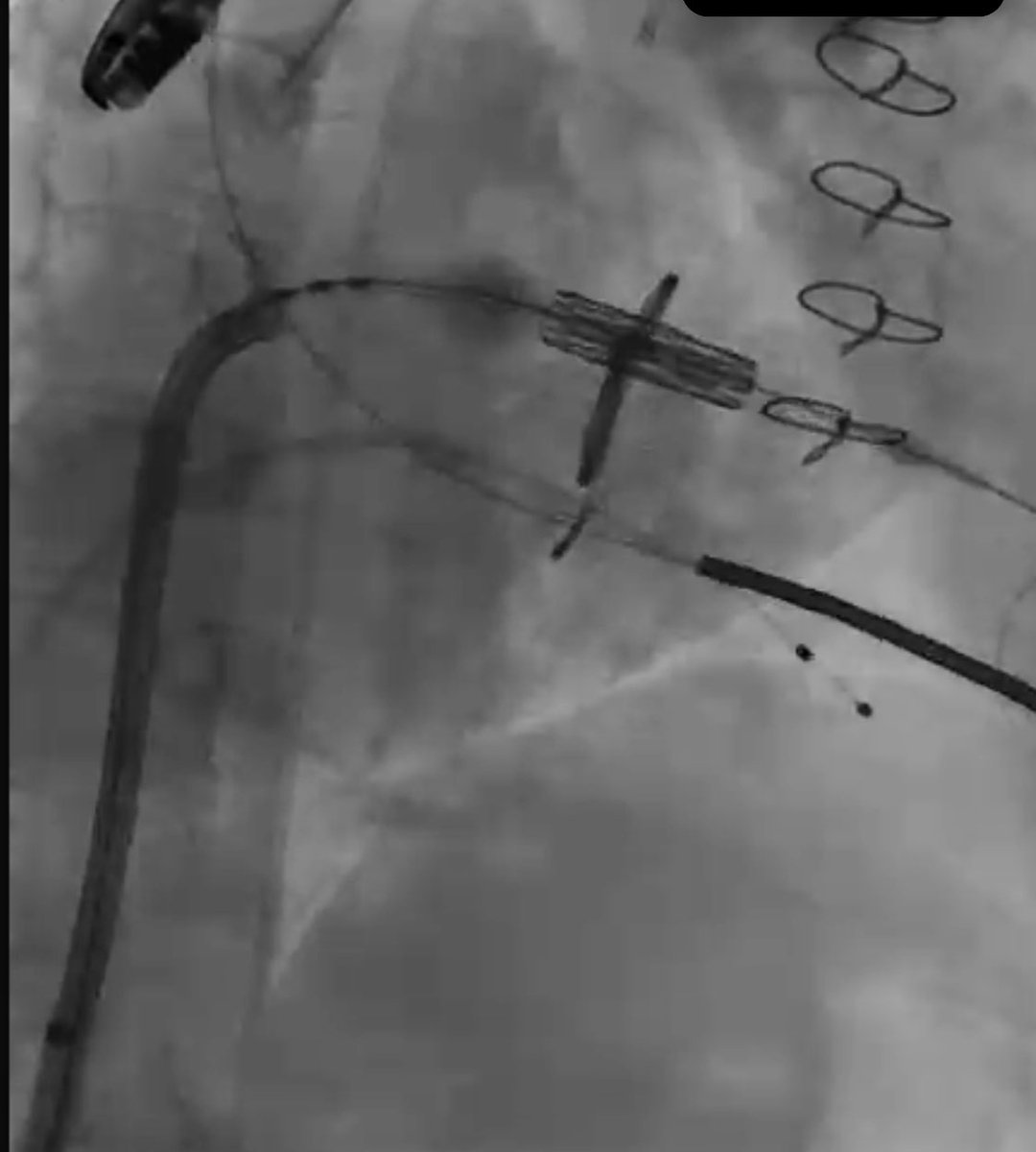 mirvatalasnag's tweet photo. #SundaySamples
#Structural♥️
🪐Oversized valve doesn’t foreshorten as much
🪐Foreshortening is usually atrial side, so start 60:40 to end w 80:20 or 90:10
🪐 Pusher back will allow u to push THV but if u need to position Ant or Post, u need pusher close https://t.co/Jxkm1gFBDb