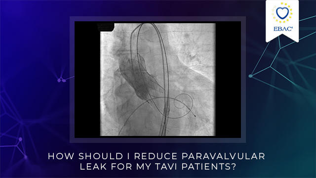 PCRonline's tweet photo. How should I reduce paravalvular leak for my #TAVI patients? How can I reduce PVL by optimizing procedural steps?

Register for this #PCRWebinar with @DaveDrdavesmith A. Camuglia &amp; M. Kang-Yin Lee on Tuesday 12 October 11am Paris 🕚5pm 🇸🇬time 🕔! https://t.co/vWc5Jnk0vG #TAVR https://t.co/UdFaGSjBfh