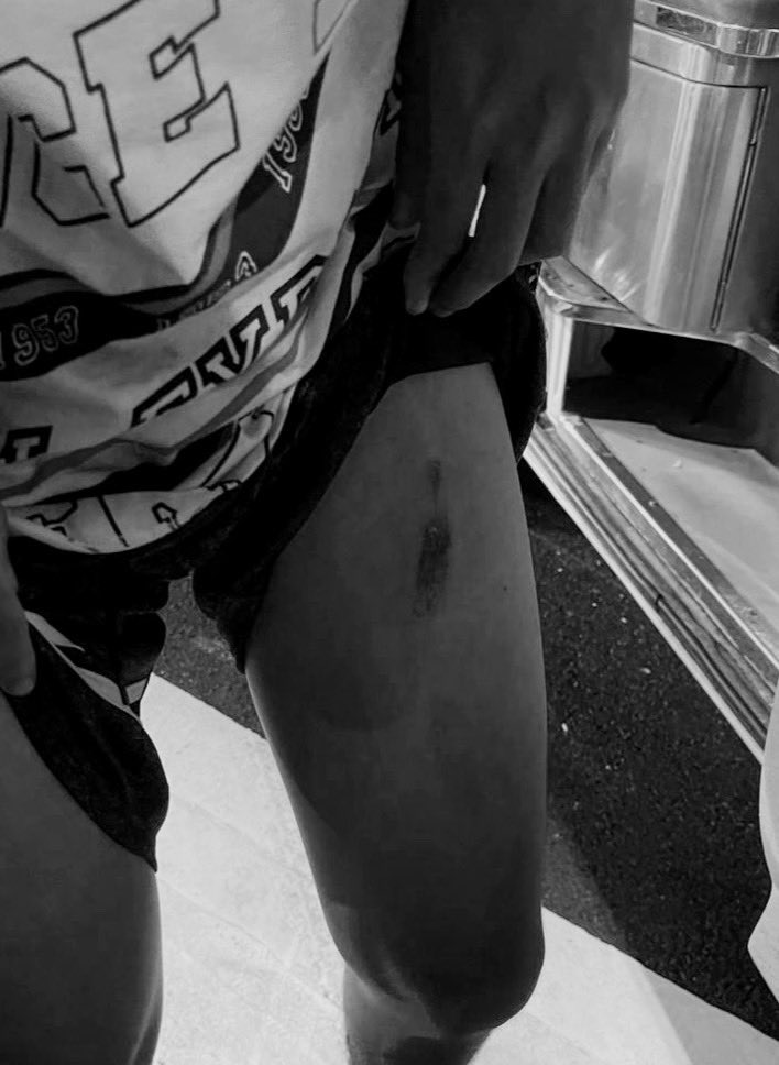 plodaek's tweet photo. TW; BLOOD 
.
รับเคส
- เยาวชนถูกระดมยิงกระสุนยาง
- คุณลุงที่จะเดินมาทานข้าวถูกยิงกระสุนยางเข้าใต้ตา ไม่เกี่ยวข้องต่อการชุมนุมแต่อย่างใด
#ม็อบ3ตุลา https://t.co/SMft6jDdrm