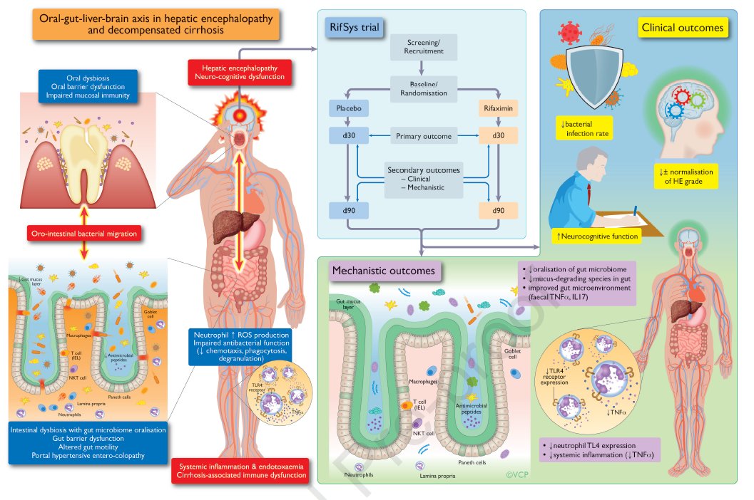ebtapper's tweet photo. Rifaximin strengthens gut barrier in patients with #cirrhosis: RCT

Take homes:
1⃣@VishCPatel /@DebbieShawcros1 combo is 🔥
2⃣Rif's effect on gut microbiota clearer now
3⃣Study is small, some baseline diffs. Larger trial needed #livertwitter https://t.co/ptTOAqHk13 https://t.co/VtkqILUSxE