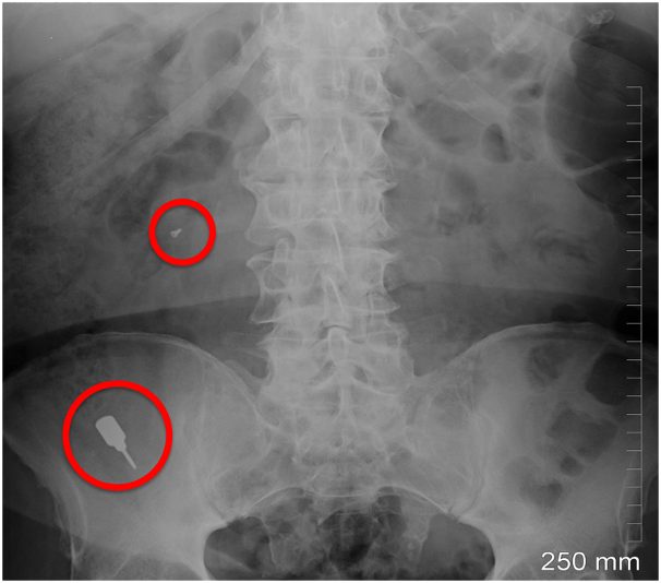 MischInstitute's tweet photo. Studies have shown that lost dental implant objects in the oropharynx may either be swallowed (stomach) or aspirated (lungs). 

What percent of the time will the object be aspirated into the lungs?

#SundayTrivia #ImplantComplications #MischResnik https://t.co/mV7GMsDEzp