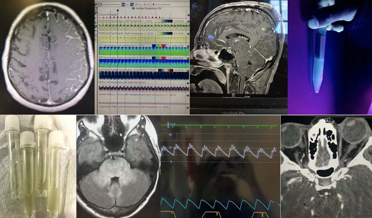caseyalbin's tweet image. 1/
Was moving #neuroimages from my iPhone into my imaging files & came across so many awesome teaching cases!
So for everyone else procrastinating something (cough, boards) here's a more fun guessing game from some awesome cases. #FOAMncc #neurocritical