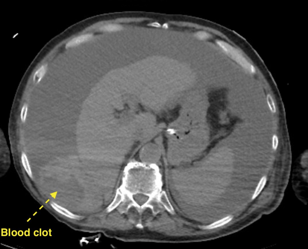 ICU stories: Elderly pt w PMHx of CAD/COPD/CKD/DM2/cirrhosis c/b esoph varices + ascites requiring p...