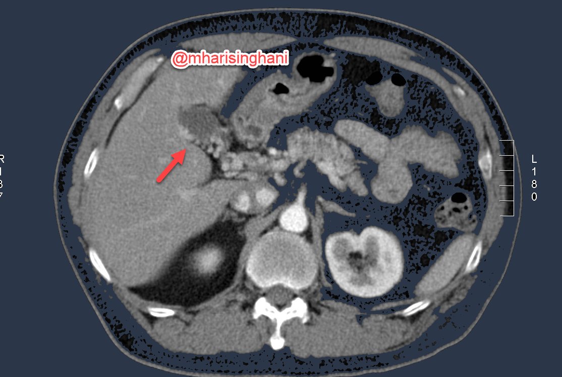 GB wall varicosities in cirrhosis; a potential source of bleed if you do a percutaneous cholecystostomy or even cholecystectomy