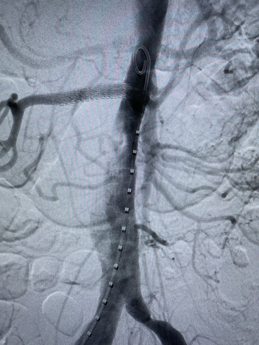 DanielMilesMD (@danielmilesmd) on Twitter photo Great break from the SVS Moore Course: symptomatic TBAD with high-risk features = TEVAR + right RA stent and excellent result! <a href="/MoridzadehMD/">Rameen S. Moridzadeh, MD</a> <a href="/VascularSurgCS/">Cedars-Sinai Division of Vascular Surgery</a> <a href="/VascSurgLA/">Vascular Surgery Associates</a> <a href="/DeptSurgeryCS/">Department of Surgery at Cedars-Sinai</a> <a href="/CedarsSinai/">Cedars-Sinai</a> #AorticDissection #vascularsurgery Great break from the SVS Moore Course: symptomatic TBAD with high-risk features = TEVAR + right RA stent and excellent result! <a href="/MoridzadehMD/">Rameen S. Moridzadeh, MD</a> <a href="/VascularSurgCS/">Cedars-Sinai Division of Vascular Surgery</a> <a href="/VascSurgLA/">Vascular Surgery Associates</a> <a href="/DeptSurgeryCS/">Department of Surgery at Cedars-Sinai</a> <a href="/CedarsSinai/">Cedars-Sinai</a> #AorticDissection #vascularsurgery
