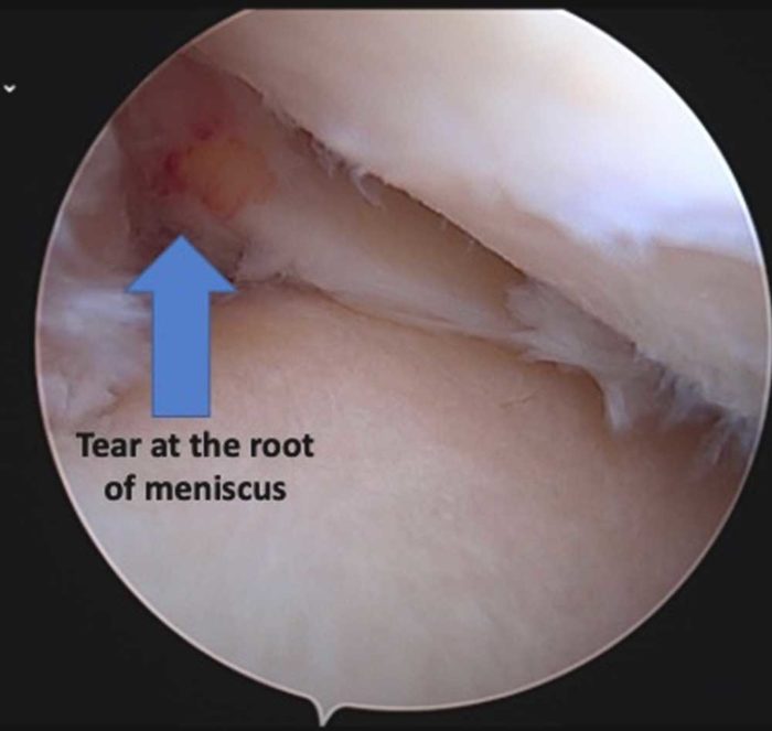 bennwachukwumd's tweet photo. Immediate & intense #kneepain can signal a #meniscusroottear especially w/pain at the back of the #knee. Patients often report hearing a “pop” at time of injury. Other common symptoms include limping, a change in the patient’s gait & the inability to...https://t.co/bNwMd4gWn6 https://t.co/0F7OBKLXro