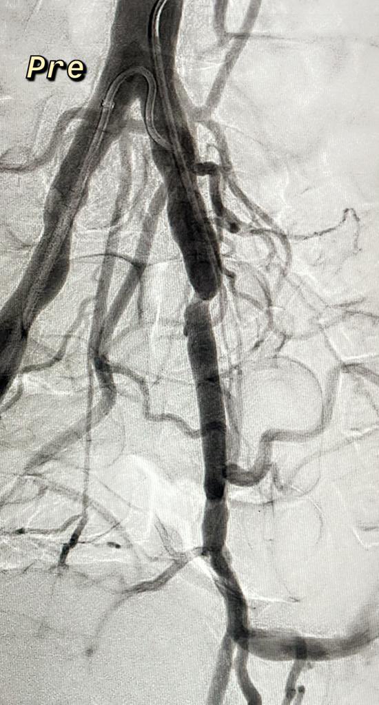 Adeebmsg's tweet photo. Recanalization, subintimal angioplasty and stenting of left external iliac artery (long segment occlusion).
توسيع ووضع دعامه في الشريان الحرقفي الخارجي الايسر بسبب انسداد مزمن.
#angioteam #ngha #jedda #sirs #irad #outback #cordis #reentry #catheter #everflex #omnilink https://t.co/mFG7O6QFx6