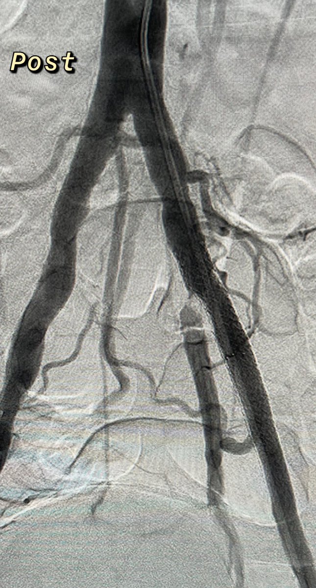 Adeebmsg's tweet photo. Recanalization, subintimal angioplasty and stenting of left external iliac artery (long segment occlusion).
توسيع ووضع دعامه في الشريان الحرقفي الخارجي الايسر بسبب انسداد مزمن.
#angioteam #ngha #jedda #sirs #irad #outback #cordis #reentry #catheter #everflex #omnilink https://t.co/mFG7O6QFx6