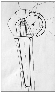 We are fortunate for the development of the RSA as it is a powerful tool for the modern shoulder surgeon. Knowing how this implant came about is an interesting evolution by Paul Grammont. Here is an excellent review of how the RSA came to be. #funfacts bit.ly/3v5snRD