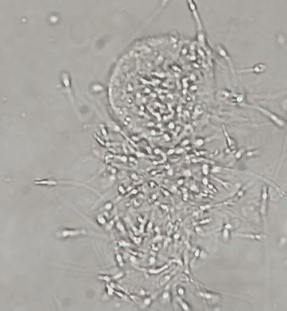 Lisaandrollab's tweet photo. @Lisaandrollab images.
#Antisperm #phagocytosis in fresh  #semen
#SemenAnalysis 
#Immunology 
#Semenimmunology 
#Spermiophages
#Espermograma https://t.co/Y34nqGZGhN