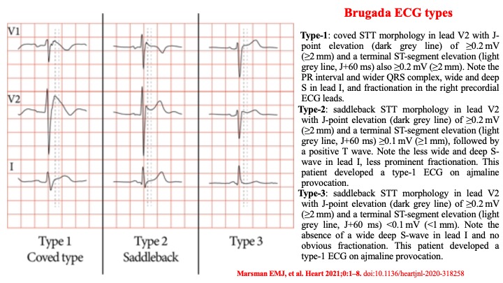 Raviele Antonio (@drraviele) on Twitter photo Fig illustrating
🖌️the different Brugada ECG types
#EPeeps #Cardiotwitter #Medtwitter <a href="/iamritu/">Ritu Thamman MD</a> <a href="/rafavidalperez/">rafavidalperez</a> <a href="/LuigiDiBiaseMD/">Luigi Di Biase</a> <a href="/adribaran/">Adrian Baranchuk MD FACC FRCPC FCCS FSIAC</a> <a href="/martinkstiles/">Martin Stiles</a> <a href="/SABOURETCardio/">SABOURETCardiologist</a> <a href="/ECGTalk/">Dr Koh Kok Wei</a> <a href="/DrJasonAndrade/">Jason Andrade</a> <a href="/GiuseppeGalati_/">Giuseppe Galati</a> <a href="/DrMarthaGulati/">Dr. Martha Gulati ♥️🫀❤️🩹🇨🇦</a> <a href="/AndreaRussoEP/">Andrea Russo</a> <a href="/EM_RESUS/">Sam Ghali, M.D.</a> dx.doi.org/10.1136/heartj… Fig illustrating
🖌️the different Brugada ECG types
#EPeeps #Cardiotwitter #Medtwitter <a href="/iamritu/">Ritu Thamman MD</a> <a href="/rafavidalperez/">rafavidalperez</a> <a href="/LuigiDiBiaseMD/">Luigi Di Biase</a> <a href="/adribaran/">Adrian Baranchuk MD FACC FRCPC FCCS FSIAC</a> <a href="/martinkstiles/">Martin Stiles</a> <a href="/SABOURETCardio/">SABOURETCardiologist</a> <a href="/ECGTalk/">Dr Koh Kok Wei</a> <a href="/DrJasonAndrade/">Jason Andrade</a> <a href="/GiuseppeGalati_/">Giuseppe Galati</a> <a href="/DrMarthaGulati/">Dr. Martha Gulati ♥️🫀❤️🩹🇨🇦</a> <a href="/AndreaRussoEP/">Andrea Russo</a> <a href="/EM_RESUS/">Sam Ghali, M.D.</a> dx.doi.org/10.1136/heartj…