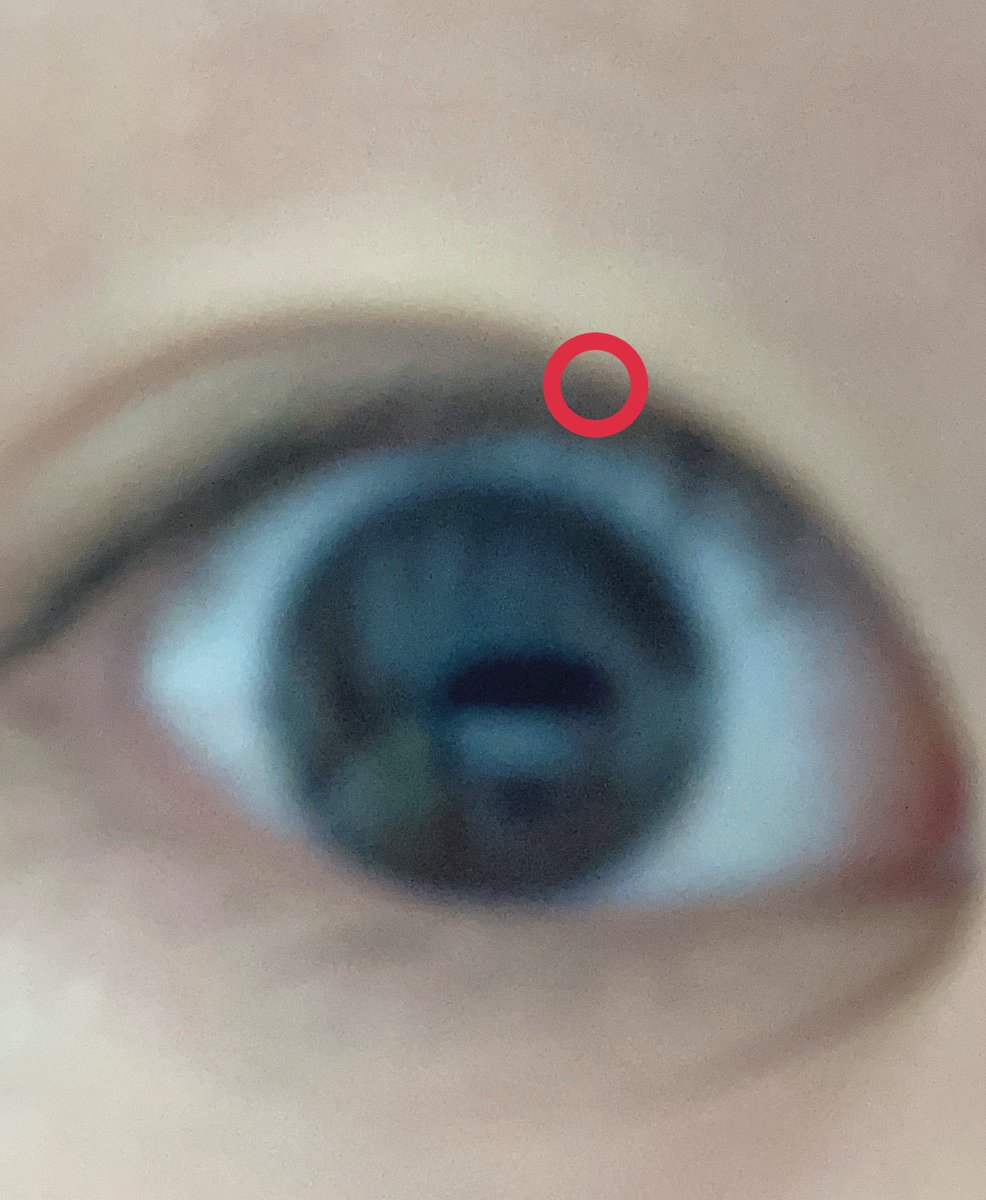 un_skp18's tweet image. 〈3日目〉
なんと二重線が二つあることが今日発覚した笑
2枚目が私がなりたい二重です笑
若干二重が始まってるところが違うのわかるかな〜(共感求む)

アイプチをする時には気をつけましょう。

＃100日後に二重になるJK 
＃3日目
#一緒に頑張ってくれる人募集中