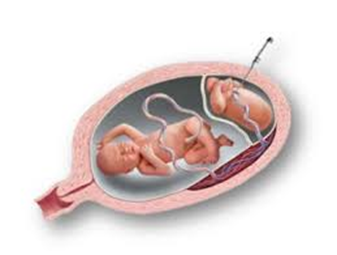 AOGS_tweets's tweet photo. Selective #termination before 18 weeks of gestation is associated with better perinatal outcome, higher #neonatal survival, lower #fetalloss, and lower #preterm delivery rates, when compared with procedures between 18 and 23 weeks.
#openaccess
https://t.co/UwsoMH3qyp https://t.co/K1ZDpDeFvU