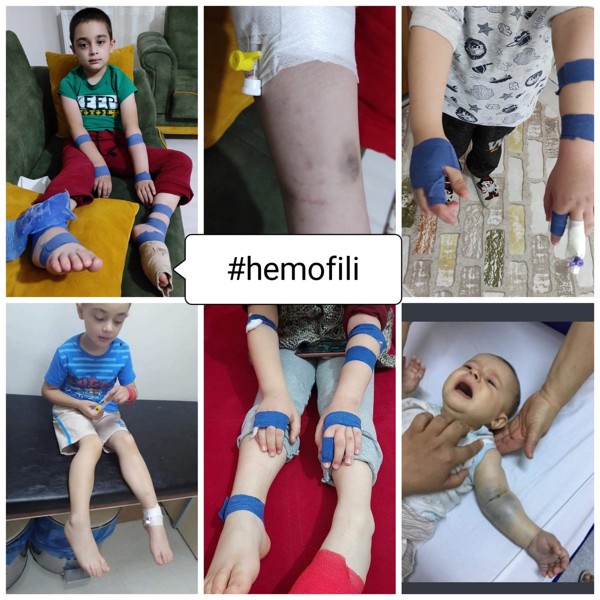Alpi070707's tweet photo. @gazetesozcu Emine hanım 26 aydır #hemofili çocukları onaylanmş #derialti ilacını bekliyor nasıl mı?
Haftada en az 3 defa damar yolu açılark oda en iyi ihtimal.
Yaşıtları okul yolunu tutarken onlar acil kapılarnda.
Bir yeri kanamasın diye aileleri tarfından pamuklra sarılarak.
@EmineErdogan https://t.co/psW2Q732x2