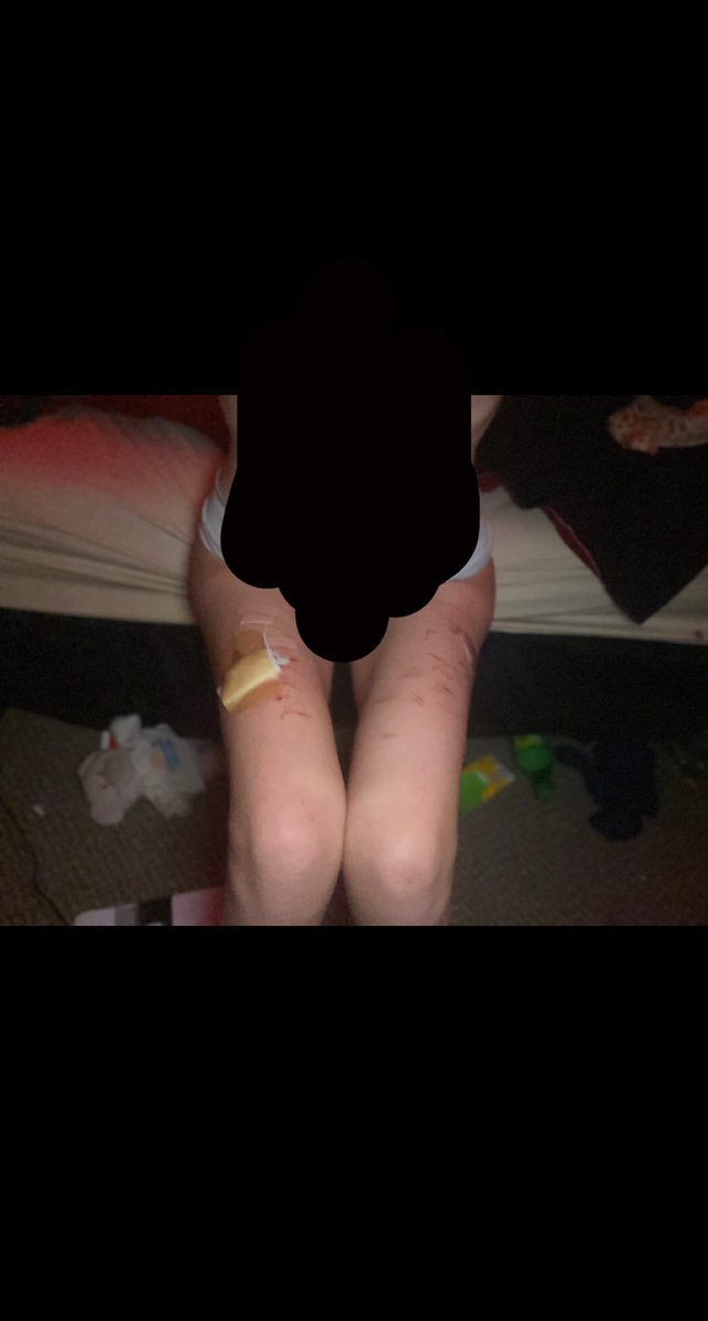 buniispo's tweet photo. bodycheck tw cuts
_
_
_
#anorexiatwt #bonespo #bonespo #ed #EDtwt #proanacoach 
_
_
_
_ https://t.co/4a0kSE2fpm