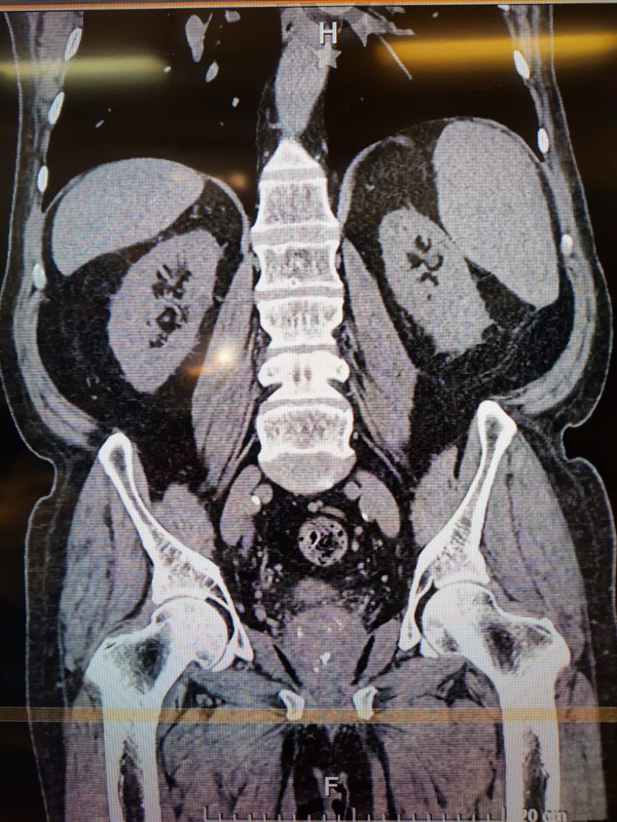 umaemac's tweet photo. Prostatectomía radical laparoscópica 🦀. #urology #urooncology #UroSoMe https://t.co/nOg8KAHECf