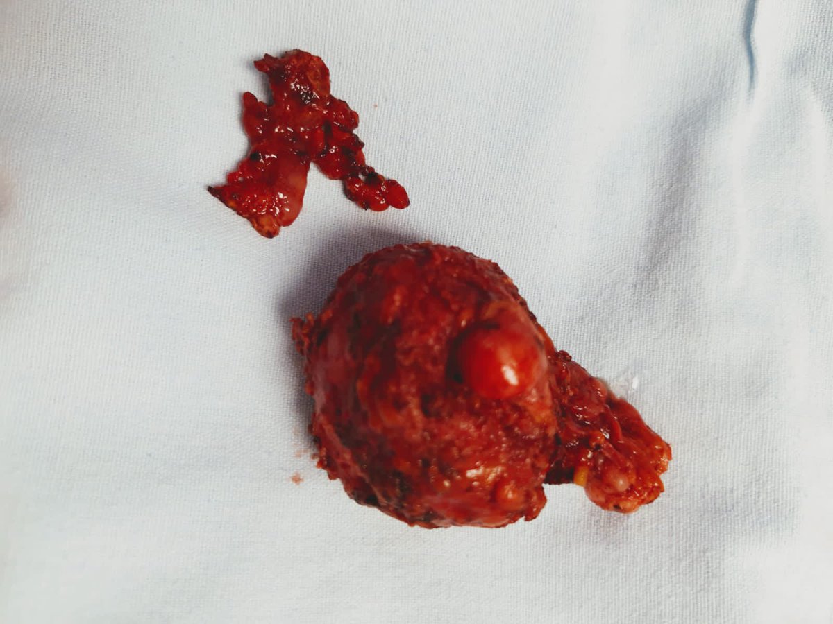umaemac's tweet photo. Prostatectomía radical laparoscópica 🦀. #urology #urooncology #UroSoMe https://t.co/nOg8KAHECf