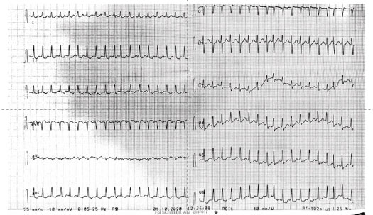 Eugene Labartkava (@elabartkava) on Twitter photo can you explain abrupt R-R shortening during narrow QRS SVT with short R-P` ? where is the problem? <a href="/EPeeps/">e__peeps</a> <a href="/javadm20/">javad mikaeili</a> <a href="/syamkumarmd/">Syamkumar</a> <a href="/MaruanCarlos/">Maruan C Chabbar</a> <a href="/ecgrhythms/">Arnel Carmona</a> <a href="/soumd/">🇺🇦✊ 👻 Dr. SPouKY 🎃 (서성만/徐成萬) 🩺🫀</a> <a href="/UlhasDr/">Dr Ulhas Pandurangi</a> can you explain abrupt R-R shortening during narrow QRS SVT with short R-P` ? where is the problem? <a href="/EPeeps/">e__peeps</a> <a href="/javadm20/">javad mikaeili</a> <a href="/syamkumarmd/">Syamkumar</a> <a href="/MaruanCarlos/">Maruan C Chabbar</a> <a href="/ecgrhythms/">Arnel Carmona</a> <a href="/soumd/">🇺🇦✊ 👻 Dr. SPouKY 🎃 (서성만/徐成萬) 🩺🫀</a> <a href="/UlhasDr/">Dr Ulhas Pandurangi</a>