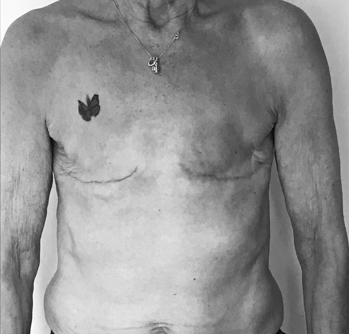 mastectomynet's tweet photo. #becomevisible #daysixteen #flatclosure #bcam #bcsm #bccww
.
"If we are to translate the silence surrounding breast cancer into LANGUAGE and ACTION against this scourge, then the first step is that women with mastectomies must become visible to each other." #audrelorde https://t.co/vzDt5BXjK0
