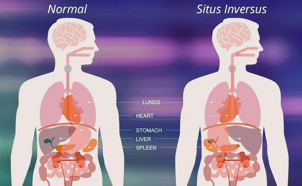 Steevydoc103's tweet image. Un peu moins d&apos;une personne sur dix mille a des organes en mode miroir. Leur coeur ne se situe, par exemple, pas à gauche, mais à droite. On appelle cette particularité le situs inversus.
Le terme situs inversus (en français : position inverse)