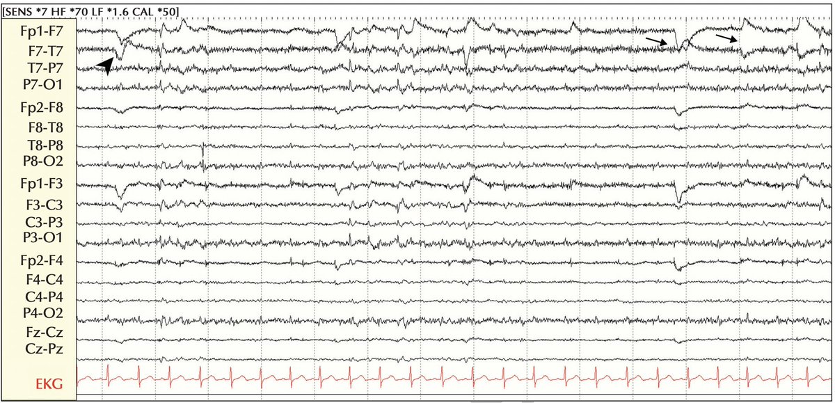 fabnascimen's tweet photo. @AMoosaMD & colleagues reported 2 patients whose EEGs showed asymmetric eye movement artifacts due to unilateral retinal detachment and resultant altered corneo-retinal potentials. Take a peek πbelow! @SBeniczky @EpiDisorders @IlaeWeb @yesILAE
https://t.co/cNRhRotmfd https://t.co/ppkMfRTpnI
