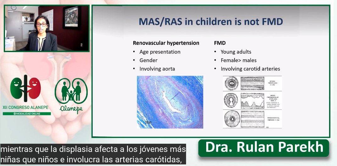 Alanepe1's tweet photo. #Alanepe2021 
@DrRulanParekh 🇨🇦showing impressive data of a large cohort of #PediatricPatients for an #uncommondisease #MidAorticSyndrome #MAS #RenalArteryStenosis #RAS from @SickKidsNews 
#TheParekhLab is characterising patients and #Hypertension outcomes
#SharingIsCaring ❤️ https://t.co/WpNMMou7pK