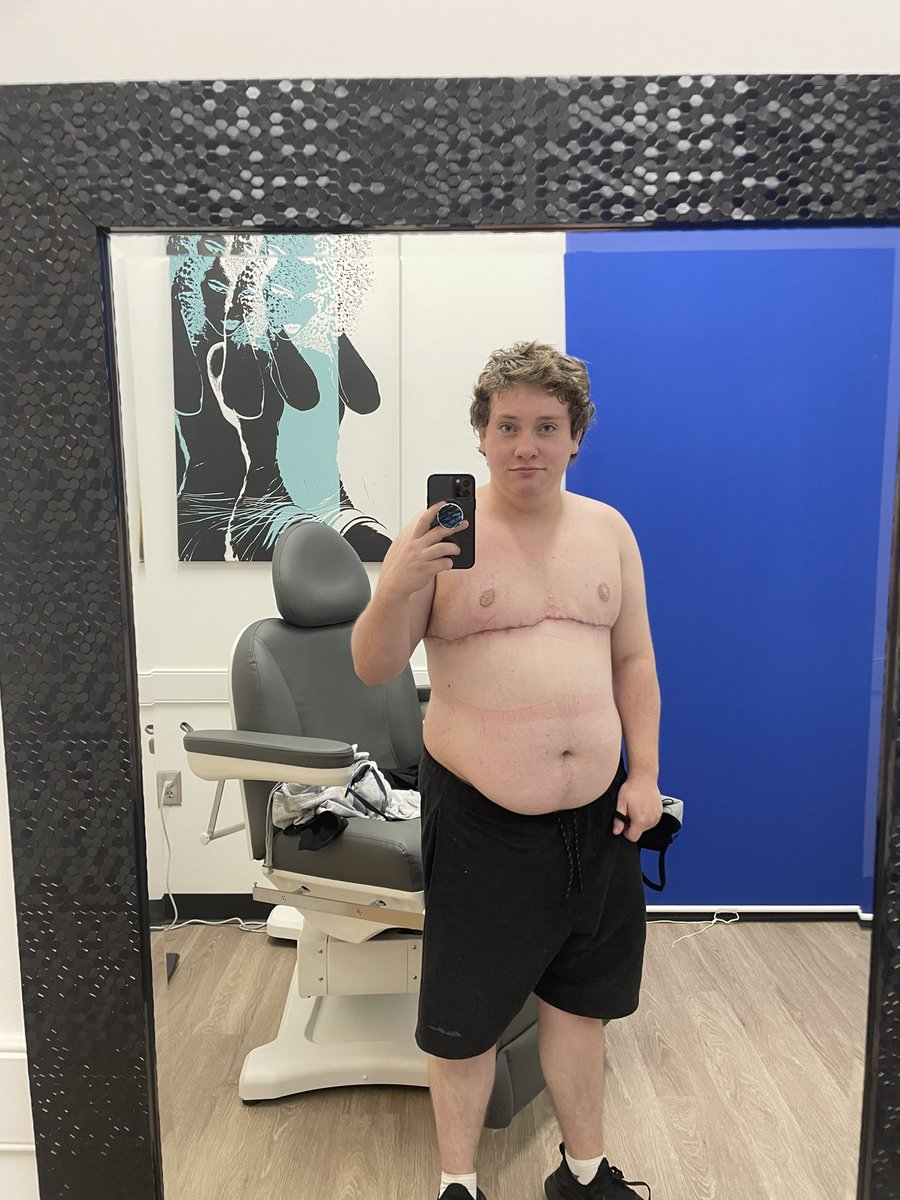 HamOnABicycle's tweet image. 6 weeks post op as of Thursday! I’ve recovered well so far and I can’t wait to see the results at 6 months!