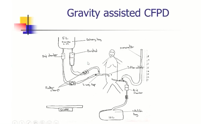 Alanepe1's tweet photo. #Alanepe2021
#ContinuesFlowPeritonealDialysis #CFPD is an option for acute therapy in patients less than 15 kg, showing promising results in small babies. Data is collecting to build evidence of effectiveness.
Options for lack of resources is gravity @TBunchman @SickKidsNews https://t.co/NObv2KOKI3