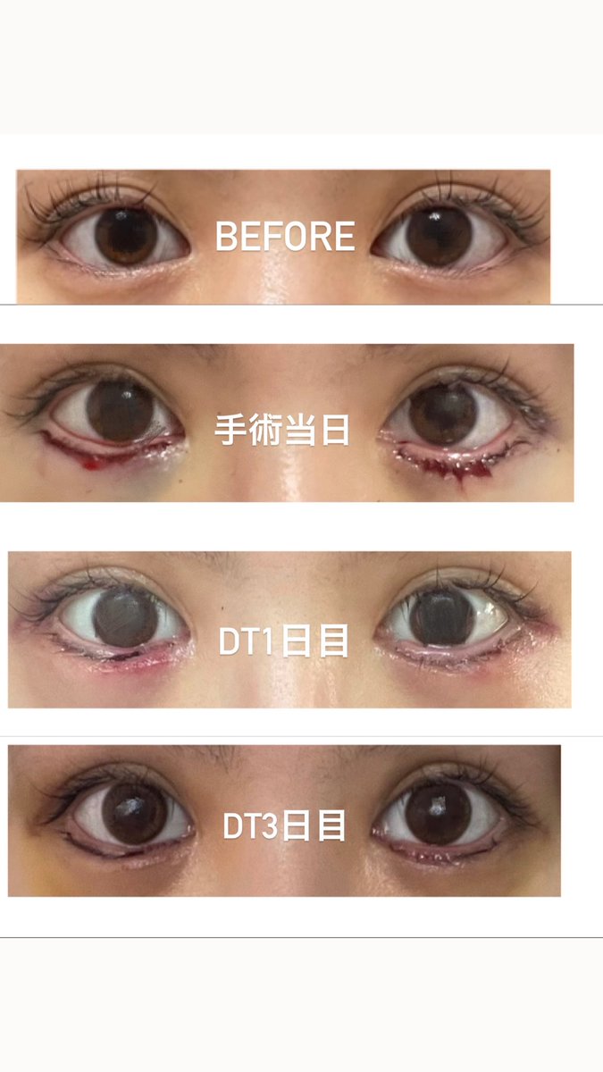 seikei_san's tweet photo. 下の逆さまつげ(保険適応)
保険医療も美容医療もやってる先生でうまい人探しまくった👼

メリットしかない！
・眼球が快適
・全体的に目が大きくなった
・中顔面短縮効果もあり https://t.co/Nt0US8DC5z