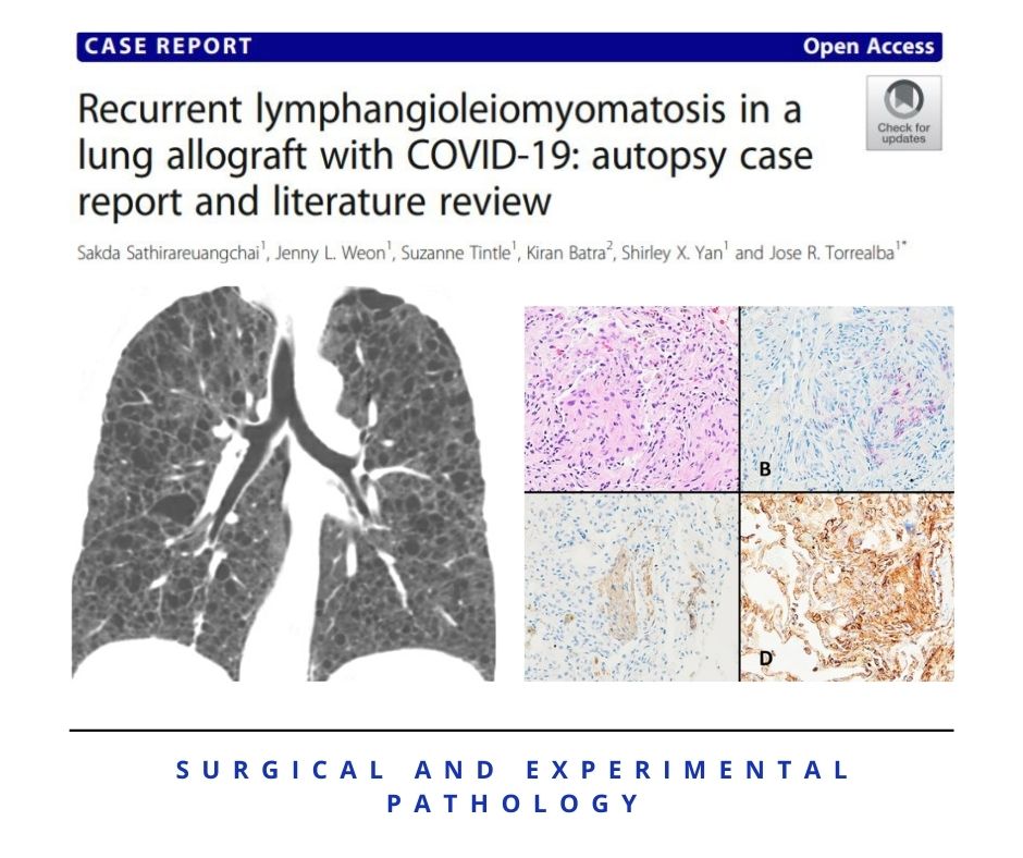 GeronimoJrLapac's tweet image. Nice case report and review !
Link (FREE): surgexppathol.biomedcentral.com/articles/10.11…
#pulmonarypath #pathology #surgicalpath #COVID19