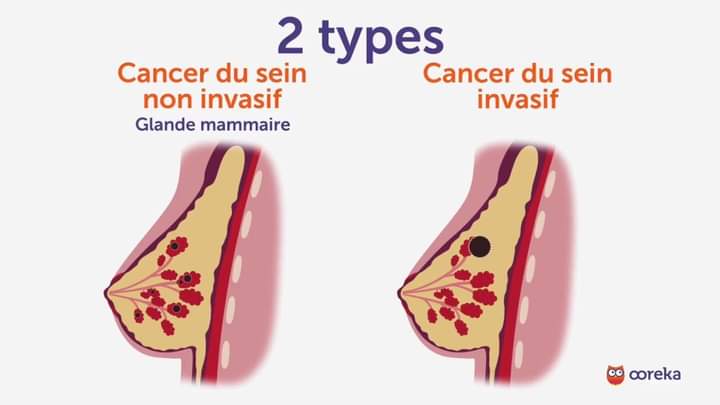 stevemoukam's tweet image. #InfluenceForHealth
#MinuteDrMoukam

⛔️ BON À SAVOIR!!

 🚨 LES PRINCIPAUX TYPES DE CANCER!!🤓

 Le Cancer du Sein est une pathologie qui attaque les seins et qui se caractérise par la MULTIPLICATION ANARCHIQUE des cellules anormales dans le sein. On va parler ce matin des
⤵️
