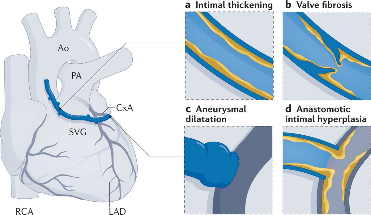 Nature Reviews Cardiology (@natrevcardiol) on Twitter photo In a new Review, <a href="/FBeerkens/">Frans Beerkens</a> <a href="/BimmerClaessen/">Bimmer Claessen</a> <a href="/derrickytam/">Dr. Derrick Tam</a> <a href="/Drroxmehran/">Dr Roxana Mehran</a> et al. discuss contemporary CABG surgery and subsequent percutaneous revascularization rdcu.be/cy0Q0 In a new Review, <a href="/FBeerkens/">Frans Beerkens</a> <a href="/BimmerClaessen/">Bimmer Claessen</a> <a href="/derrickytam/">Dr. Derrick Tam</a> <a href="/Drroxmehran/">Dr Roxana Mehran</a> et al. discuss contemporary CABG surgery and subsequent percutaneous revascularization rdcu.be/cy0Q0