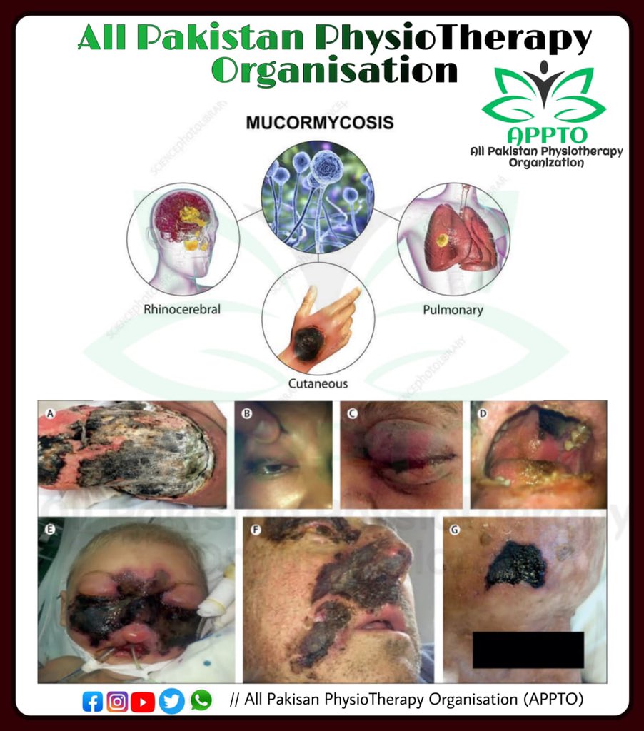 APPTO17's tweet photo. MUCORMYCOSIS.

-Mucormycosis is a serious but rare fungal infection caused by a group of molds called mucormycetes.
-Mucormycosis mainly affects people who have health problems or take medicines that lower the body's ability to fight germs and sickness.

https://t.co/GzHNsjBDzY… https://t.co/Xn99N9fsH9
