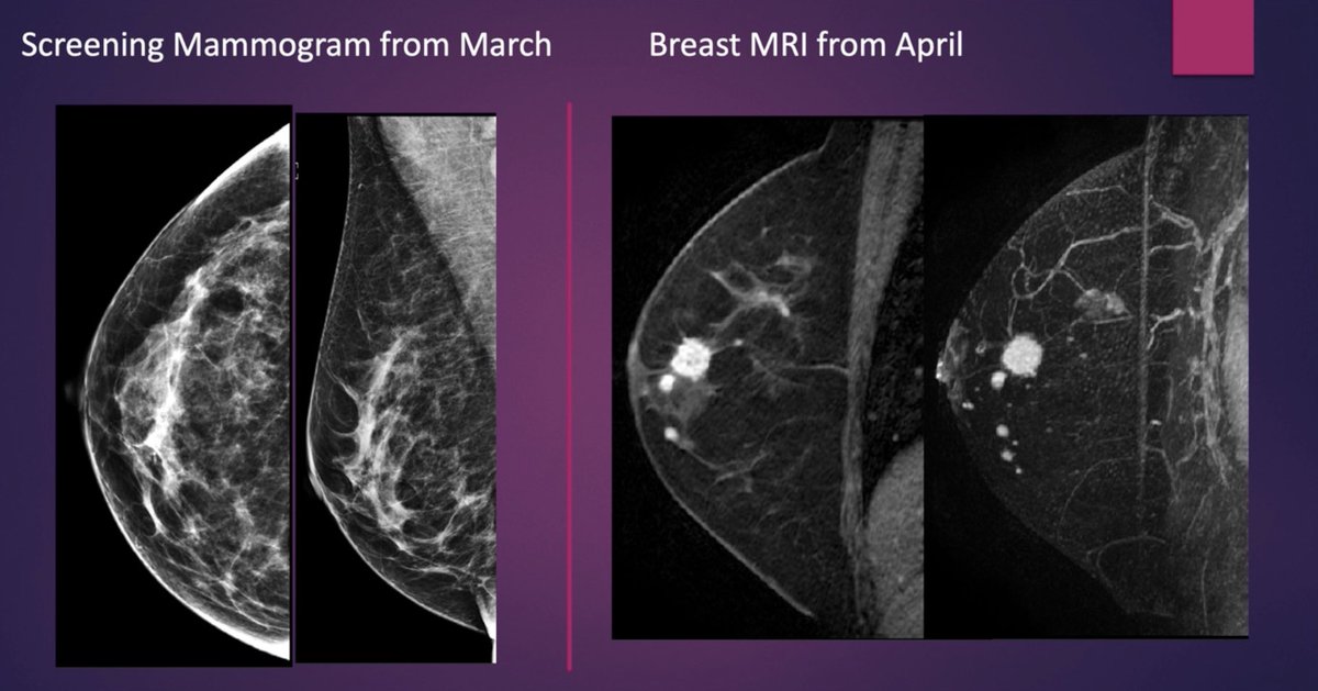 CharmiMD's tweet photo. October #BreastCancer Fact 5🎀:

Breast MRI can find almost 2.5x more invasive breast cancers in dense breasts compared to 3D mammography.

https://t.co/y6NODV7jxS

#medtwitter #radres #futureradres #bcam https://t.co/NqWbWZUgAO