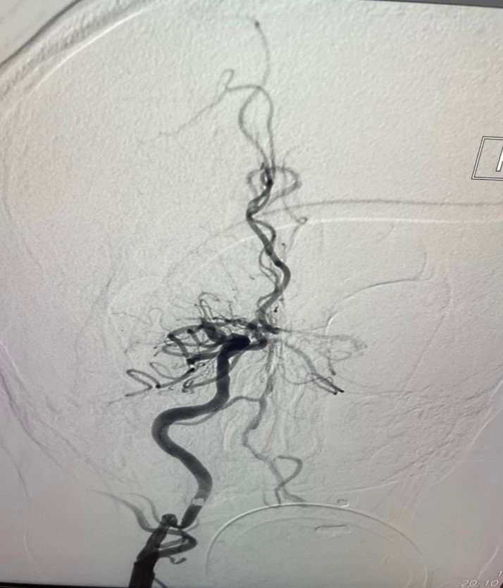 PenNeuro's tweet image. US HCPs: Recanalization with #RED68 in the hands of @radoraychev out of @StJude! #RaisingTheStandard #REDglideDifference Rx only. For indications, contraindications, warnings, precautions &amp;amp; potential adverse events see bit.ly/2BYj7Yj Clinical results vary.