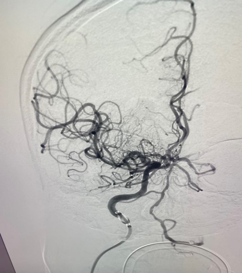 PenNeuro's tweet image. US HCPs: Recanalization with #RED68 in the hands of @radoraychev out of @StJude! #RaisingTheStandard #REDglideDifference Rx only. For indications, contraindications, warnings, precautions &amp;amp; potential adverse events see bit.ly/2BYj7Yj Clinical results vary.