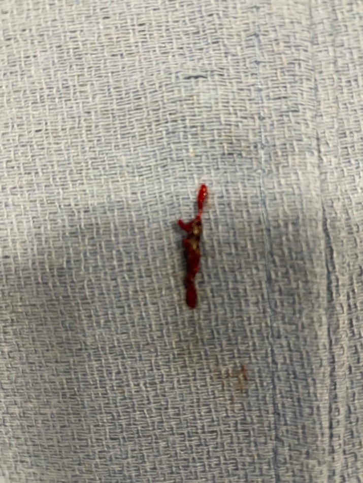 PenNeuro's tweet image. US HCPs: Recanalization with #RED68 in the hands of @radoraychev out of @StJude! #RaisingTheStandard #REDglideDifference Rx only. For indications, contraindications, warnings, precautions &amp;amp; potential adverse events see bit.ly/2BYj7Yj Clinical results vary.