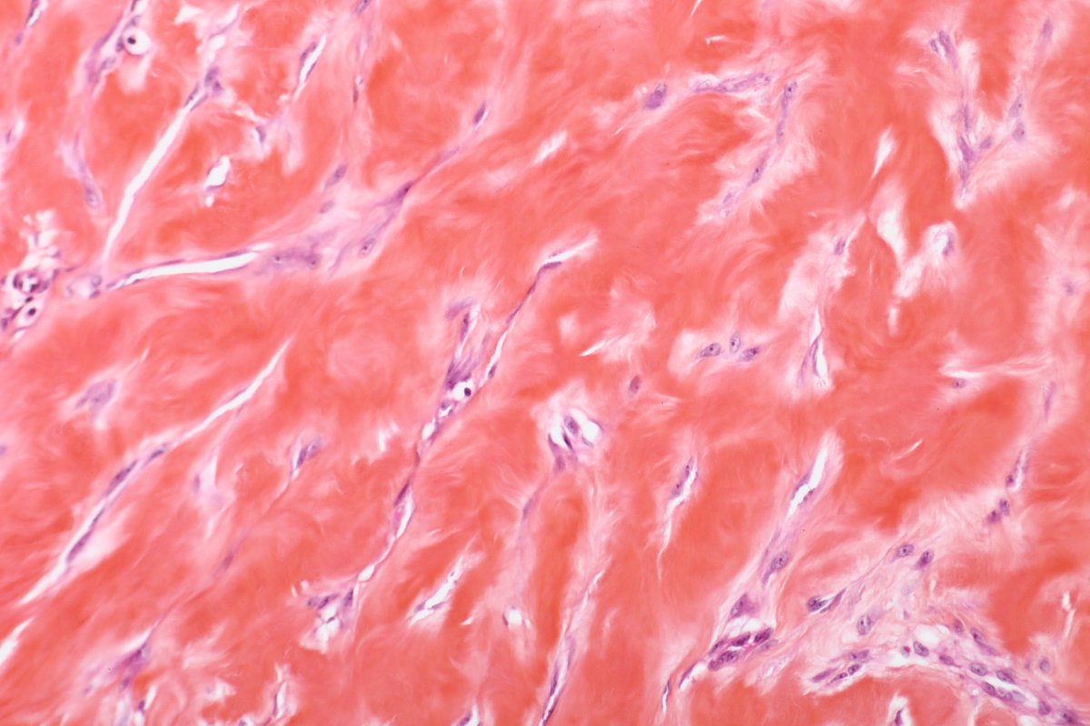 BattistellaMD's tweet photo. Just because it's beautiful - the 2 faces of keloid: hyalinized collagen (established lesion) and proliferating fibroblasts (growing lesion). HE with safron as we do in🇫🇷 #dermpath #PathTwitter #simplethingsarebeautiful https://t.co/j4qDBF32oo