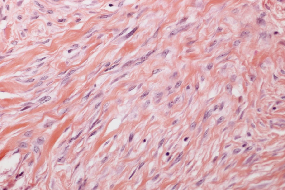 BattistellaMD's tweet photo. Just because it's beautiful - the 2 faces of keloid: hyalinized collagen (established lesion) and proliferating fibroblasts (growing lesion). HE with safron as we do in🇫🇷 #dermpath #PathTwitter #simplethingsarebeautiful https://t.co/j4qDBF32oo