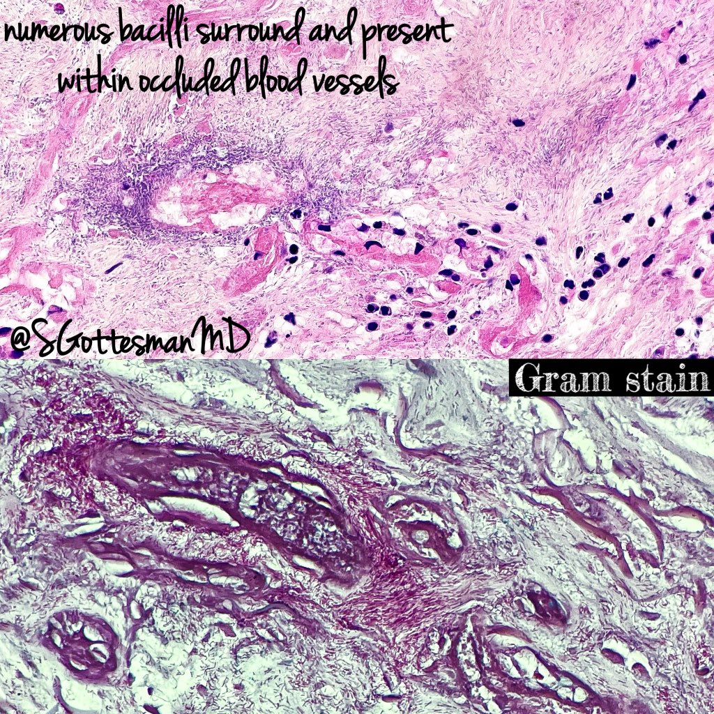 ecthyma gangrenosum histology