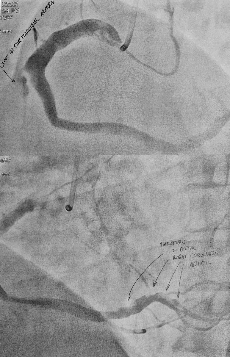 POST-VACCINE "COINCIDENCES"
Case 1

→Johnson&amp;Johnson Vaccine 2 weeks ago
→Admitted with acute heart attack (inferior STEMI)
→Right heart artery has multiple clots but no
  underlying narrowing or ruptured cholesterol 
  plaque 

Conclusion:
Vaccine-induced heart attack