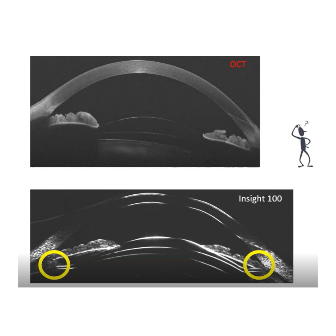 arcscaninc's tweet photo. #ArcScan is raising the standard of care for #ICL sizing and #surgery! With the #Insight100's very high resolution #ultrasound and #robotic technology, you get more anatomically correct images with 0.12mm repeatability.
Watch Dr. Rick Behrens webinar https://t.co/Wl0RAxwIMX https://t.co/teLVodkaEl