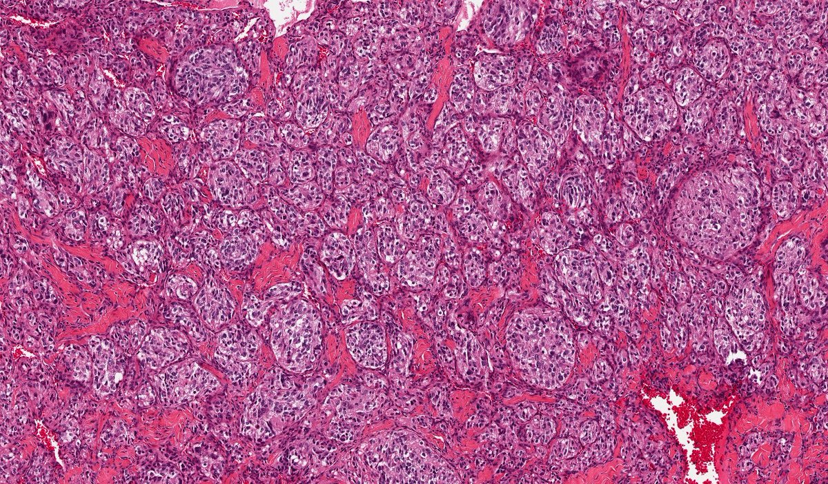 daoud_elena's tweet photo. Cauda equina tumor - we don't see this one very often. Can you guess the diagnosis? @UTSW_Pathology https://t.co/kcIBw2YaBc