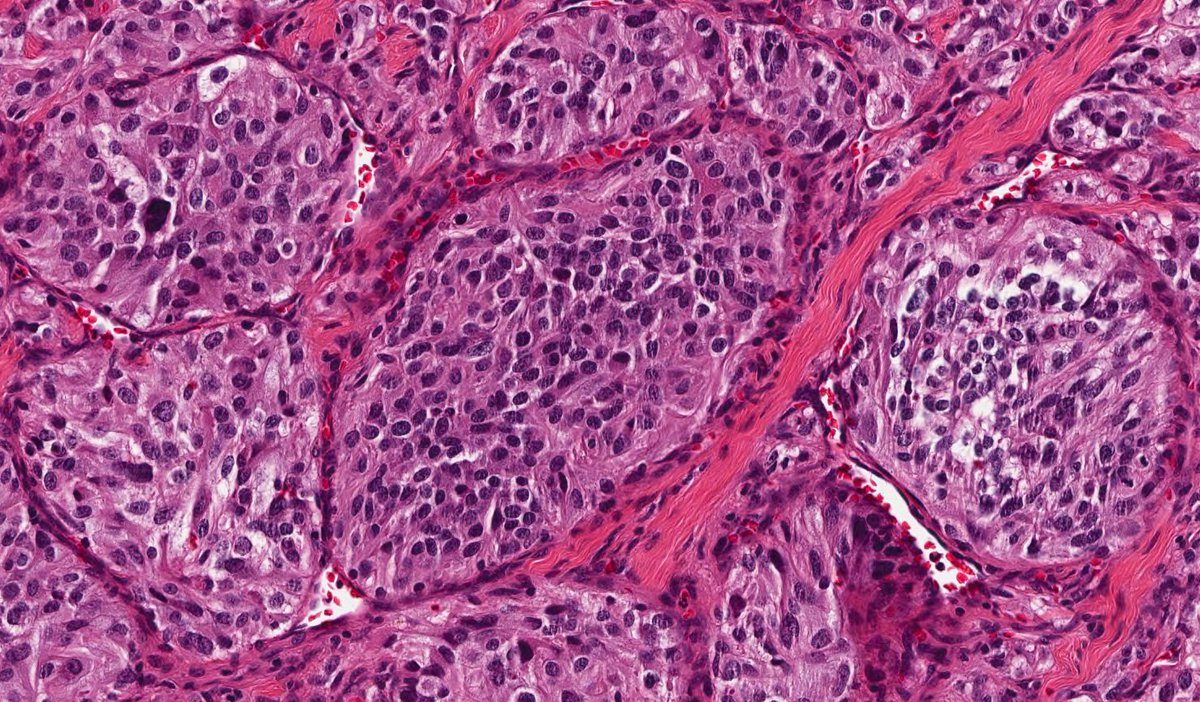 daoud_elena's tweet photo. Cauda equina tumor - we don't see this one very often. Can you guess the diagnosis? @UTSW_Pathology https://t.co/kcIBw2YaBc