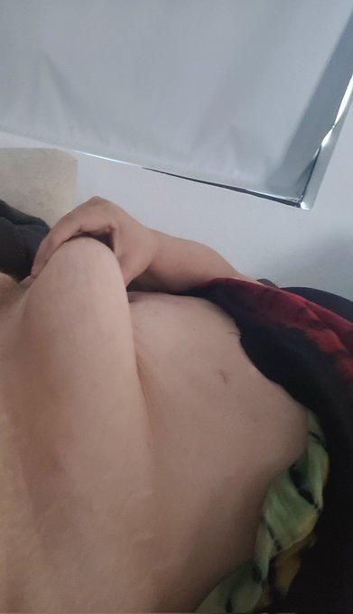 The downside of major weight loss. Soooooooo much skin. Can't wait for skin removal https://t.co/46q