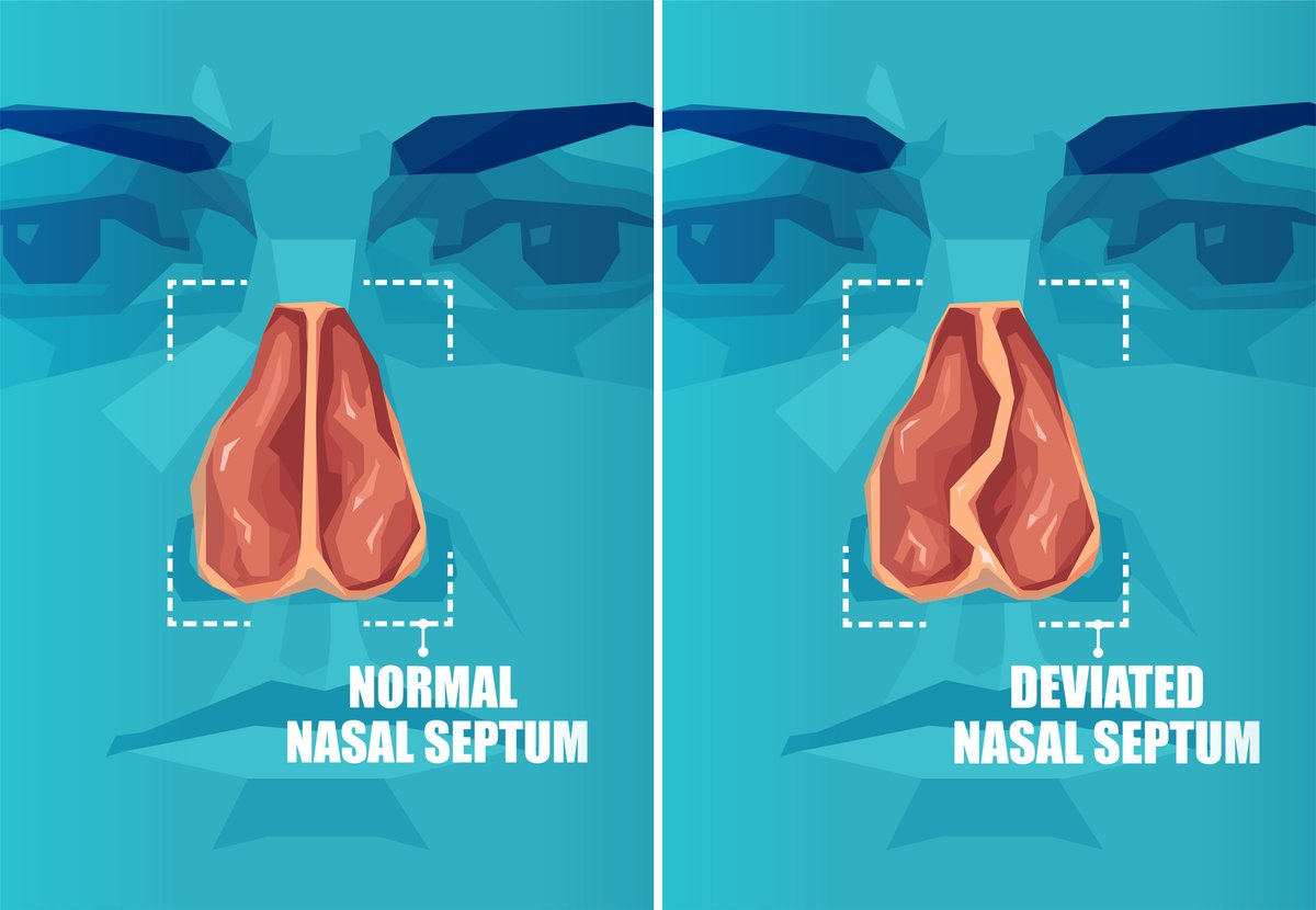 AASMorg's tweet photo. In a 9-year cohort study, researchers found that the prevalence of obstructive sleep apnea was 4.39 times higher among patients with a deviated septum compared to a control group. This finding was more pronounced with increasing BMI. @JCSMJournal https://t.co/w7uWzoVi0F https://t.co/p43S07yV6l