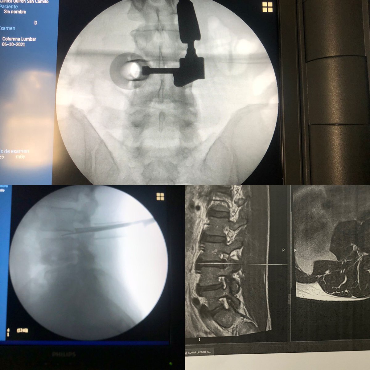DrParajon's tweet photo. #farlateral #tubular approach for #extraforaminal disc herniation.
#MinimallyInvasive #Spine Surgery. https://t.co/uXPc7F5zHZ