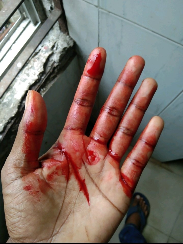 Jh_Sumon_Akando's tweet photo. হাত কেটে গেছে...😪😪 https://t.co/kueokAhZ2i