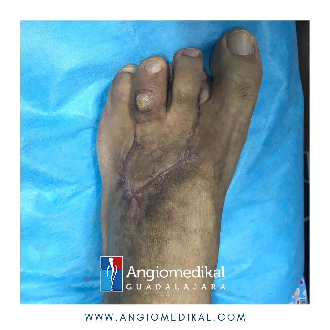 angioycvascgdl's tweet photo. ✅Salvamento de pie diabético ⭐️⭐️⭐️⭐️⭐️
💙Gracias por tu confianza!
Evita complicaciones y acude con tu Angiólogo Certificado 💜
✅Cuida tu circulación #hazloenmanosdeexpertos
🌐 https://t.co/bqTa4yRjli
#flebitis #diabetes #gangrena #clinicadepiediabetico #angiotips https://t.co/GkTTEG4BZf